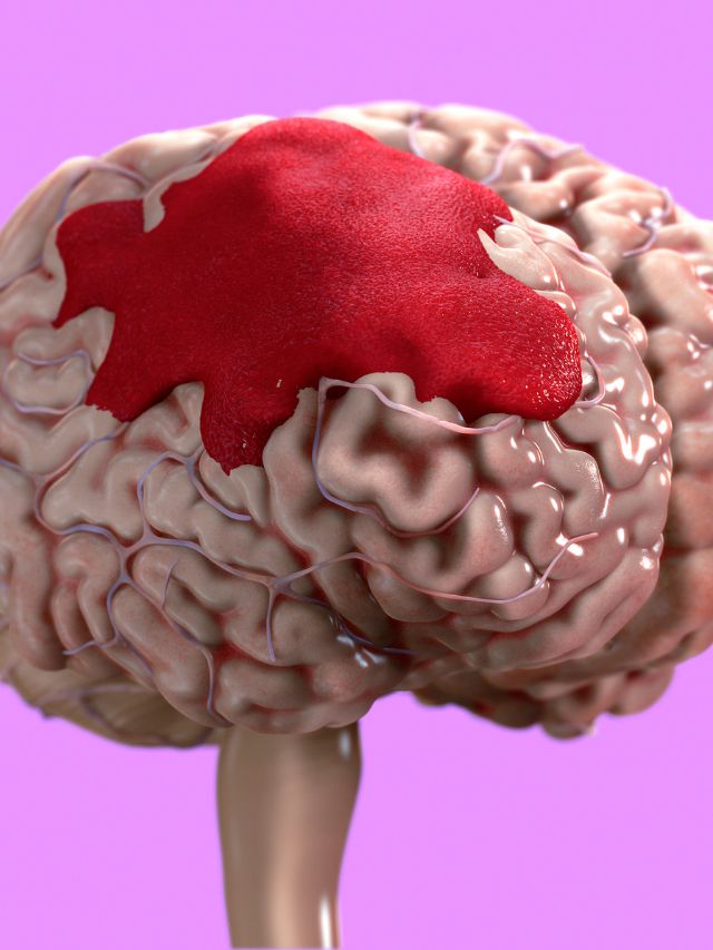 Causes of Brain Bleeding: A Simple Explanation - The Care World